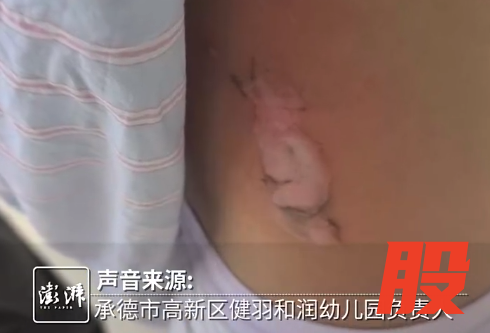 河北承德6岁女童参加幼儿园活动被烟花烫伤，区教育局：调查处理中